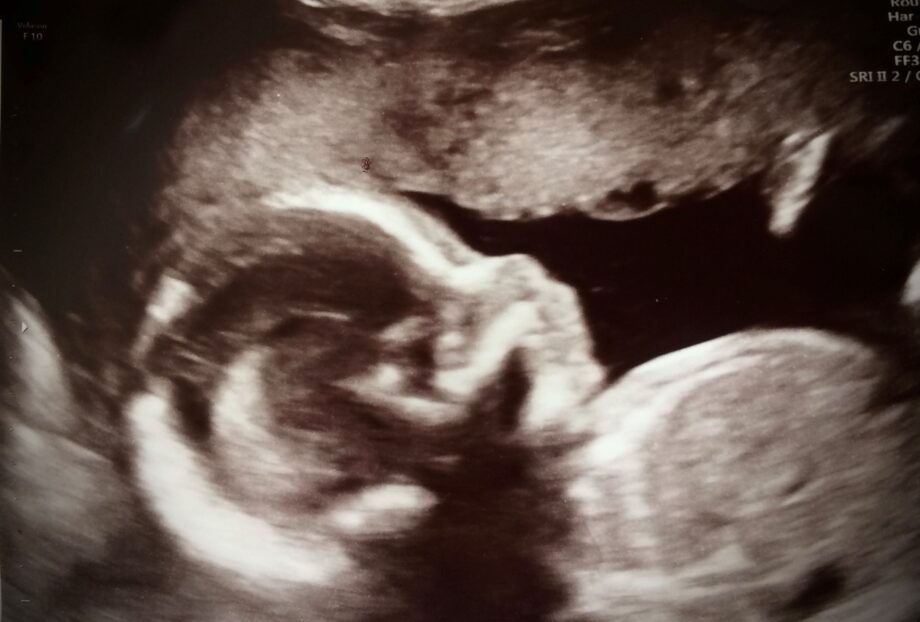 Ultraljudsbild på foster